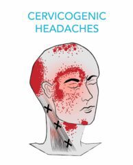  Cervicogenic Headaches Treatment in Jaipur 