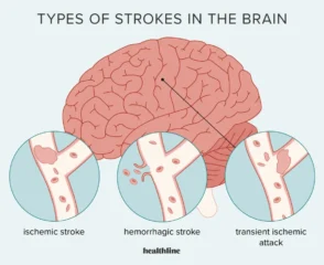 Stroke Treatment in Jaipur