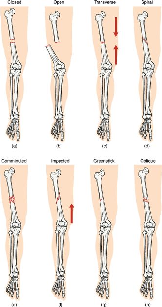 Post fracture stiffness Treatment in Jaipur