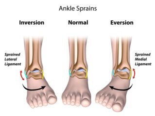 Ankle Sprains Treatment in Jaipur