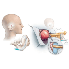 Acoustic Neuroma Treatment in Jaipur 