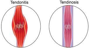 Tendinitis/Tendinosis Treatment in Jaipur