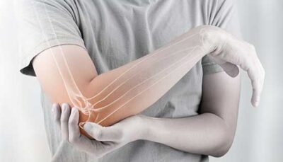 Post fracture stiffness Treatment in Jaipur 