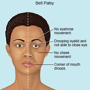 Bell’s Palsy Treatment in Jaipur