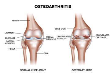 Osteoarthritis Treatment in Jaipur 