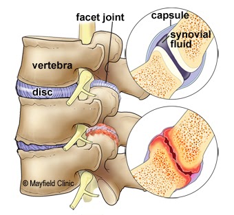 Facet dysfunctions Treatment in Jaipur 